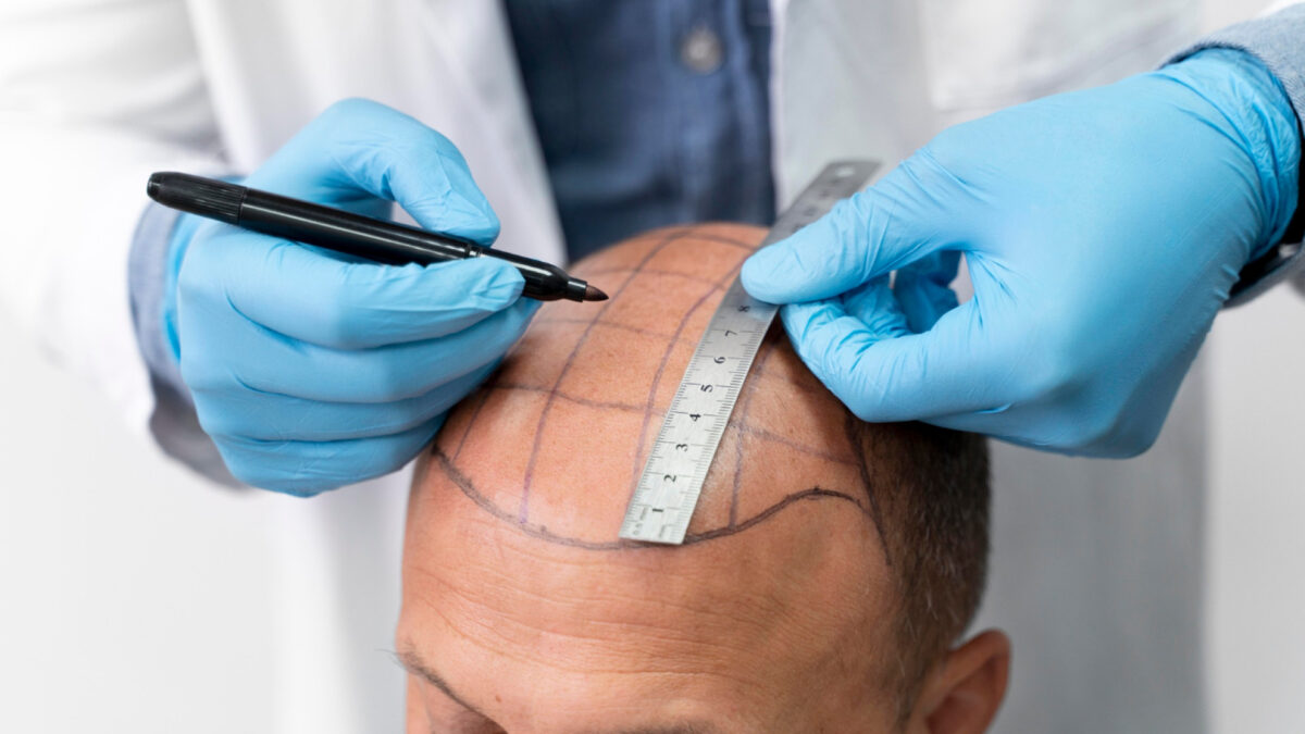 Greffe de cheveux à Lyon : l’expérience qui change votre vie !